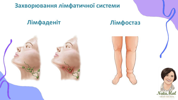 Nata. Malтвій світ твоє життя ֍ ֍ ֍ Захворювання лімфатичної системи. Лімфаденіт Лімфостаз 