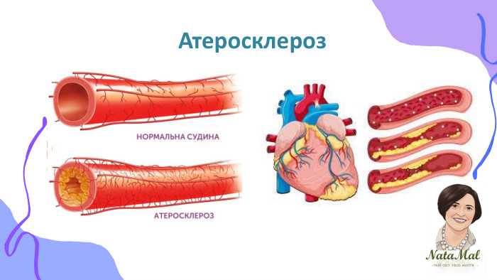 Nata. Malтвій світ твоє життя ֍ ֍ ֍ Атеросклероз