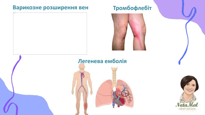 Nata. Malтвій світ твоє життя ֍ ֍ ֍ Варикозне розширення вен. Тромбофлебіт. Легенева емболія