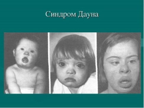 3. Признаки и симптомы синдрома Дауна у новорожденного - Синдром Дауна
