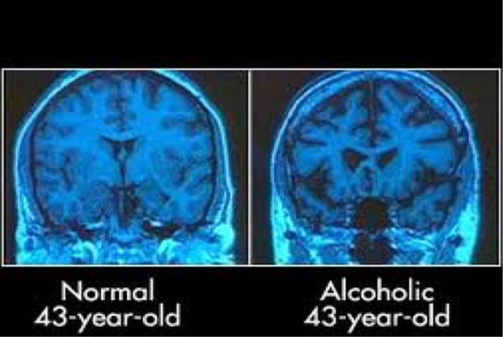 http://harchi.info/files/images/images/754-alcohol-brain.jpg