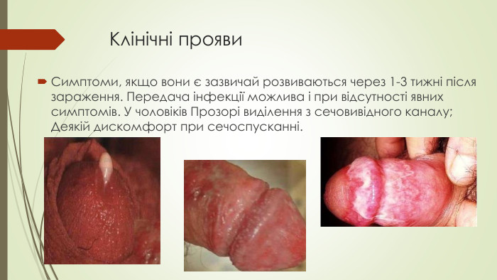 Клінічні прояви Симптоми, якщо вони є зазвичай розвиваються через 1-3 тижні після зараження. Передача інфекції можлива і при відсутності явних симптомів. У чоловіків Прозорі виділення з сечовивідного каналу; Деякій дискомфорт при сечоспусканні.