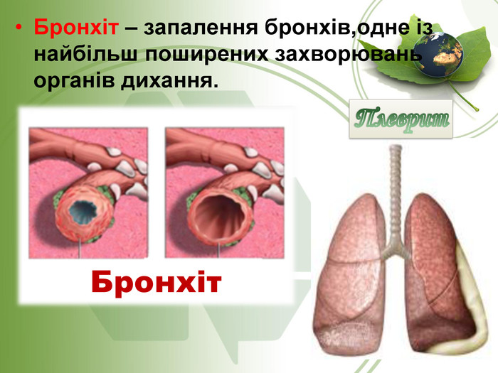 Бронхіт – запалення бронхів,одне із найбільш поширених захворювань органів дихання. Бронхіт 