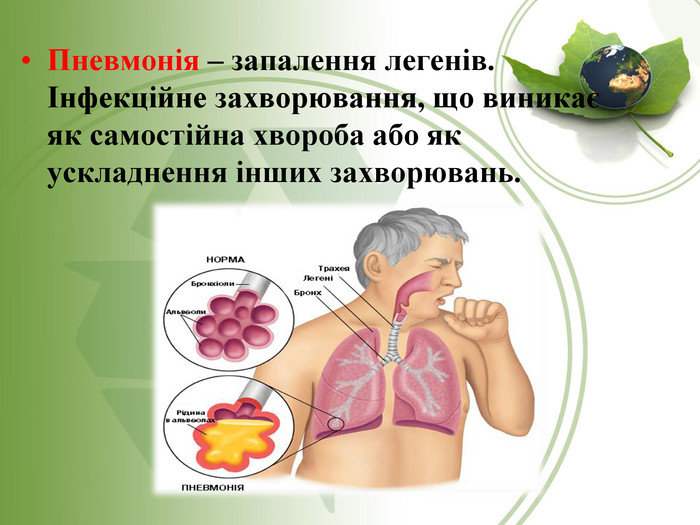 Пневмонія – запалення легенів. Інфекційне захворювання, що виникає як самостійна хвороба або як ускладнення інших захворювань. 