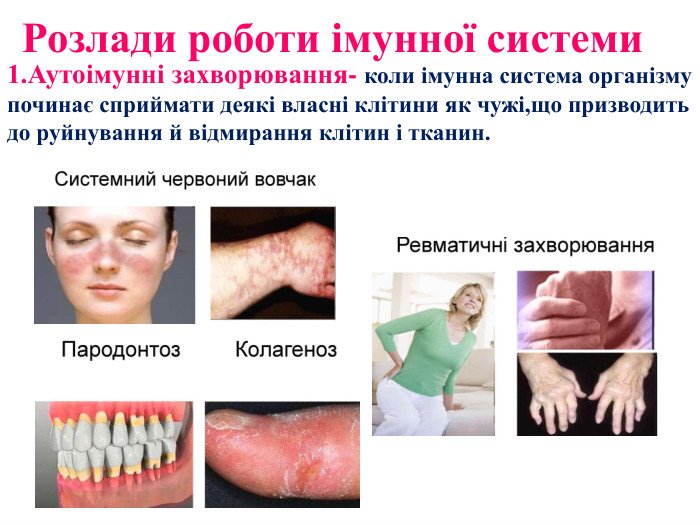 Розлади роботи імунної системи 1. Аутоімунні захворювання- коли імунна система організму починає сприймати деякі власні клітини як чужі,що призводить до руйнування й відмирання клітин і тканин.