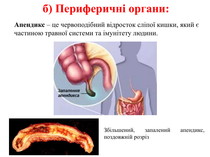 б) Периферичні органи: Апендикс – це червоподібний відросток сліпої кишки, який є частиною травної системи та імунітету людини. Збільшений, запалений апендикс, поздовжній розріз