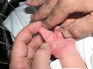Файл:New born boy showing complete complex syndactyly with two fingers right hand.JPG