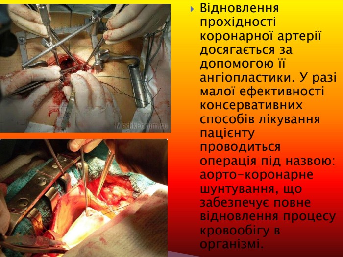Відновлення прохідності коронарної артерії досягається за допомогою її ангіопластики. У разі малої ефективності консервативних способів лікування пацієнту проводиться операція під назвою: аорто-коронарне шунтування, що забезпечує повне відновлення процесу кровообігу в організмі. 
