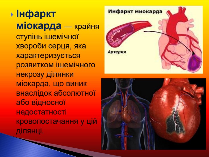 Інфаркт міокарда — крайня ступінь ішемічної хвороби серця, яка характеризується розвитком ішемічного некрозу ділянки міокарда, що виник внаслідок абсолютної або відносної недостатності кровопостачання у цій ділянці.  