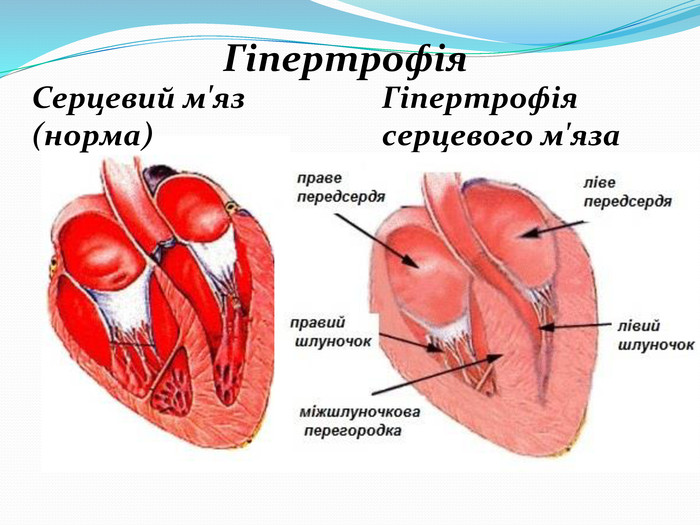  Гіпертрофія Гіпертрофія серцевого м'яза Серцевий м'яз (норма)