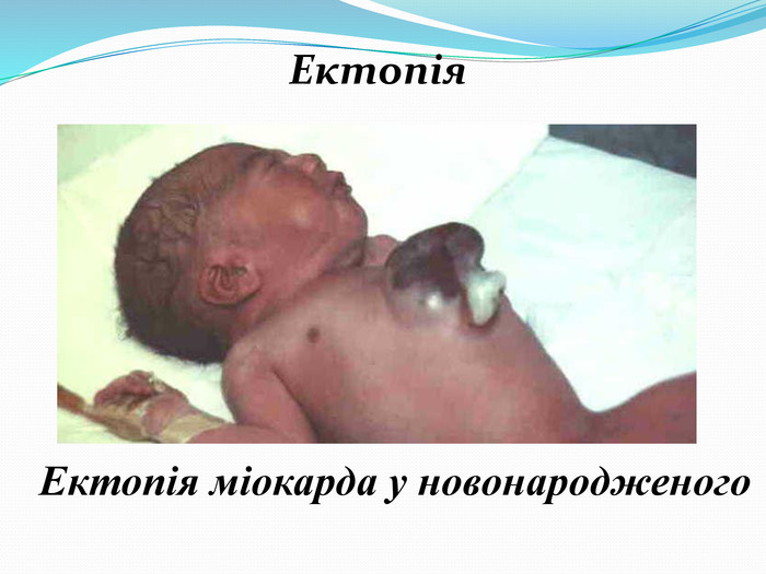  Ектопія. Ектопія міокарда у новонародженого