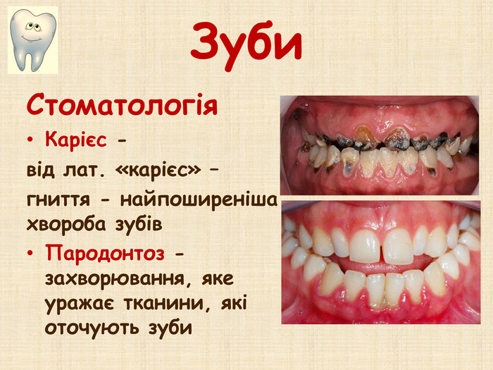 Зуби. Стоматологія. Карієс -від лат. «карієс» – гниття - найпоширеніша хвороба зубів. Пародонтоз - захворювання, яке уражає тканини, які оточують зуби